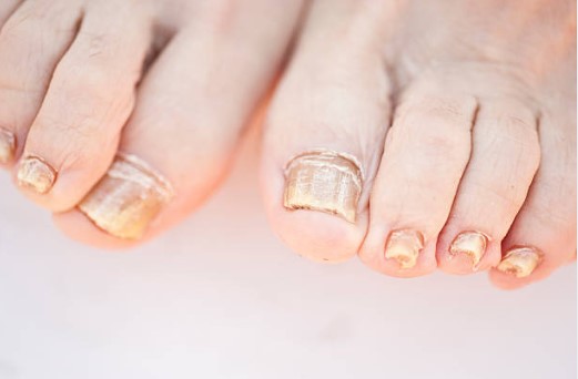 Jak poznat plíseň nehtů a prstů na nohou?